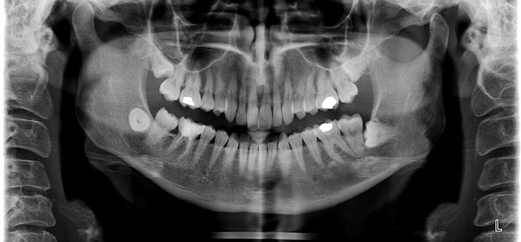 x ray