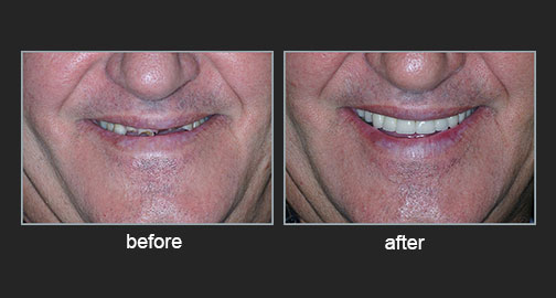 Extensive loss of tooth surfaces with a decrease in the vertical dimension of the face due to gastroesophageal reflux disease