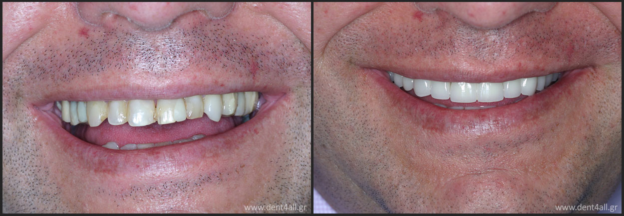 Dental repair