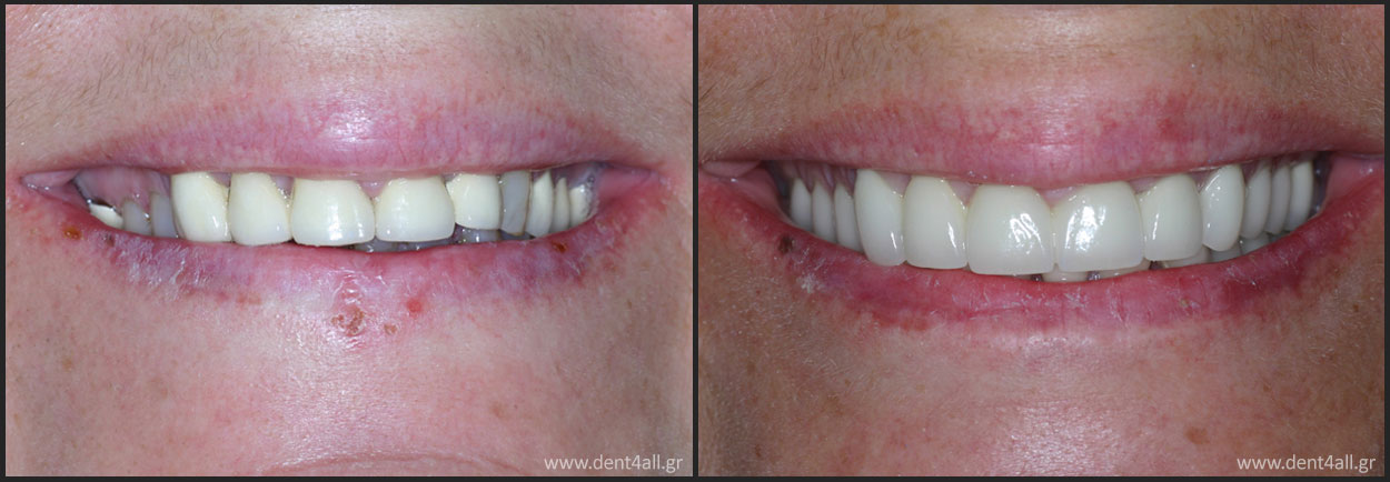 Dental repair