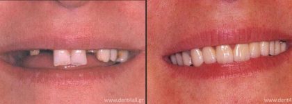Dental repair